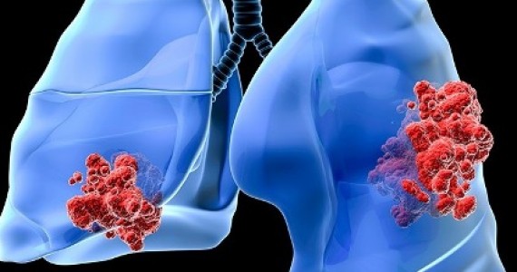 În Marea Britanie, peste o mie de persoane dezvoltă cancer pulmonar din cauza poluării