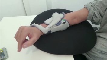 Sistemul Bioness aduce soluții inovatoare pentru persoanele care au suferit accidente vasculare cerebrale. Cum facilitează recuperarea