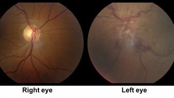 Pacienții cu NAION ar putea beneficia de un tratament revoluționar. Terapia promite să „întoarcă timpul”