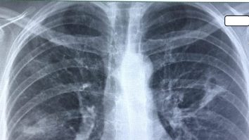 Tuberculoza ar putea fi eradicată dacă ar exista mai multă finanțare pentru sănătatea publică în SUA