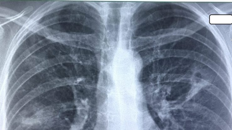 Tuberculoza ar putea fi eradicată dacă ar exista mai multă finanțare pentru sănătatea publică în SUA