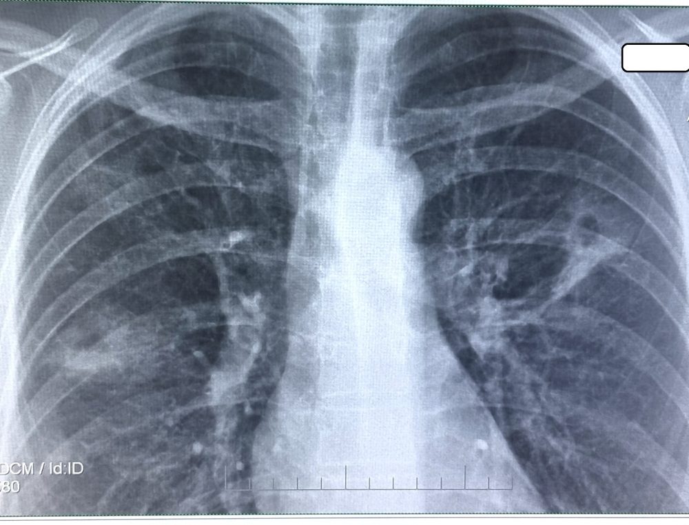 Tuberculoza ar putea fi eradicată dacă ar exista mai multă finanțare pentru sănătatea publică în SUA
