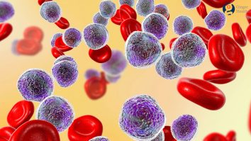 28 Mai este declarată Ziua Mondială a Cancerului de Sânge. Dan Coriu, medic hematolog: „Recomandăm analize periodice, mai ales după 50 de ani”