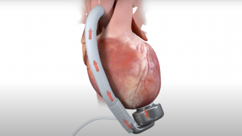 În premieră mondială, prima pompă cardiacă cu membrană ondulată a fost implantată cu succes în Australia