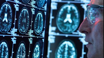 Cercetătorii de la Harvard au descoperit că LITIUL poate proteja creierul de îmbătrânirea cauzată de Alzheimer