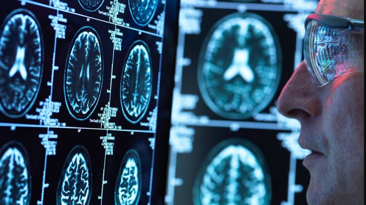Cercetătorii de la Harvard au descoperit că LITIUL poate proteja creierul de îmbătrânirea cauzată de Alzheimer