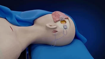 Un implant cerebral revoluționar permite unui om paralizat să controleze roboți. Cum cercetătorii chinezi au întrecut Neuralink