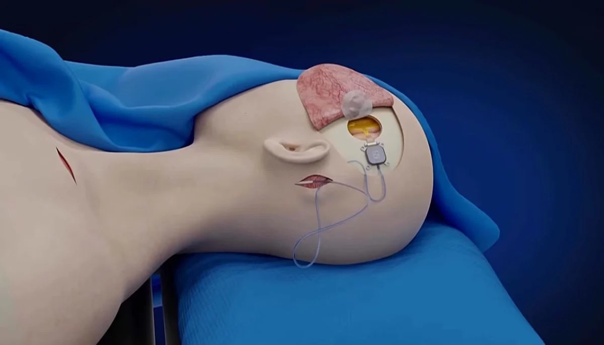 Un implant cerebral revoluționar permite unui om paralizat să controleze roboți. Cum cercetătorii chinezi au întrecut Neuralink