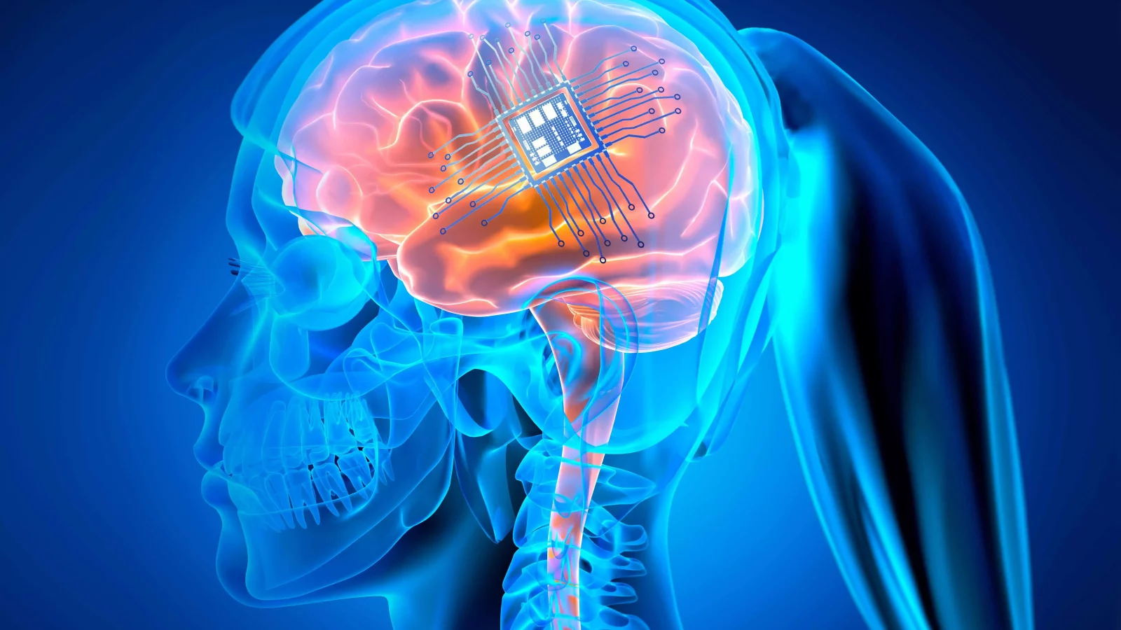 Paradromics, rivalul companiei Neuralink a lui Musk, a implantat cu succes primul cip în creierul unei paciente paralizate. Implantul promite redarea vorbirii